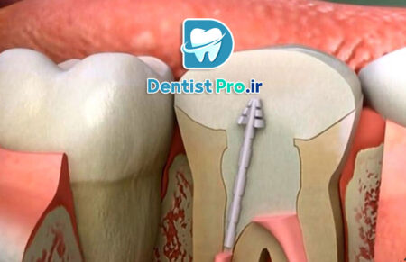 آیا عصب کشی دندان در یک جلسه امکان پذیر است؟