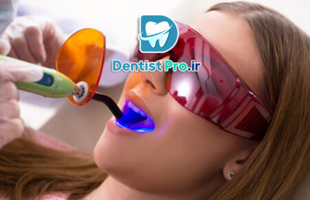 پر کردن دندان با کامپوزیت نانو مقاوم