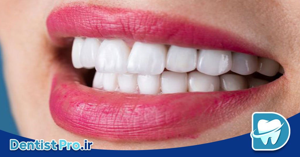 پر کردن دندان با کامپوزیت نانو مقاوم