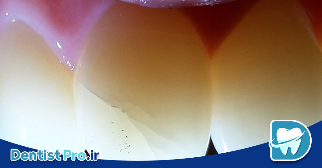 درمان دندان ترک خورده بدون کشیدن