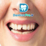 درمان دندان ترک خورده بدون کشیدن