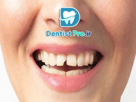 درمان دندان ترک خورده بدون کشیدن