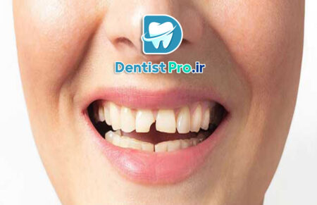 درمان دندان ترک خورده بدون کشیدن