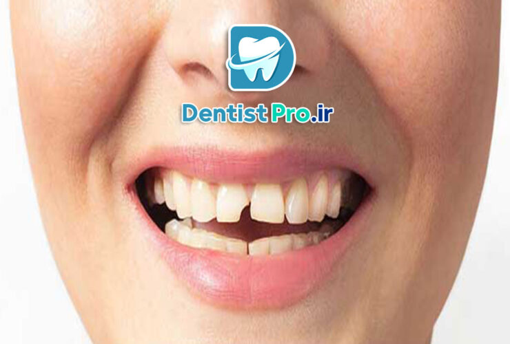 درمان دندان ترک خورده بدون کشیدن 39 درمان دندان ترک خورده بدون کشیدن