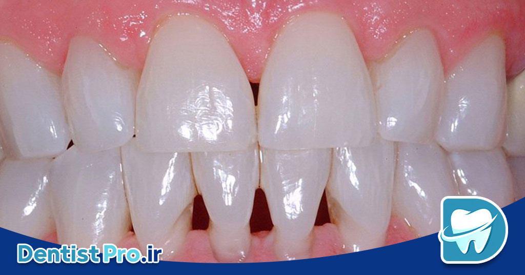 درمان تحلیل لثه با جراحی بازسازی بافت