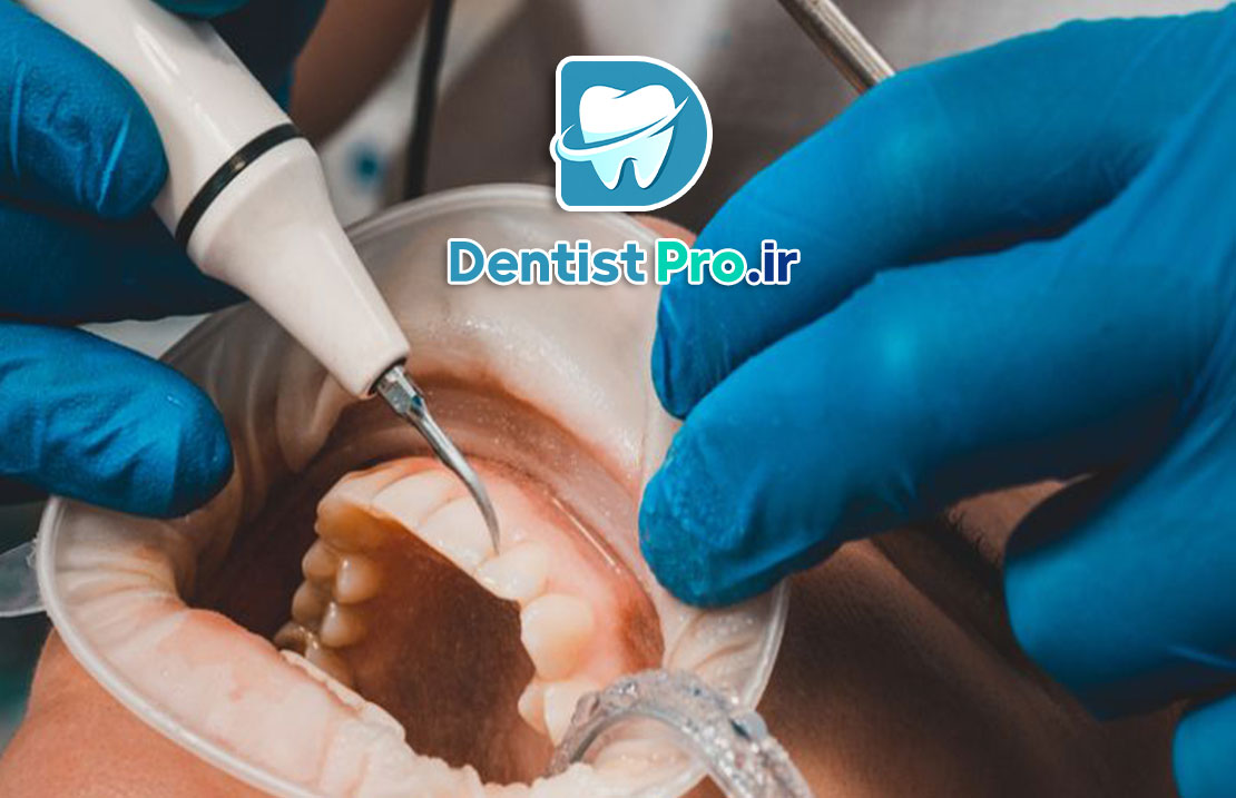 درمان تحلیل لثه با جراحی بازسازی بافت