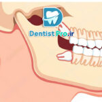 کشیدن دندان عقل با کمترین تورم: راهنمای جامع و علمی