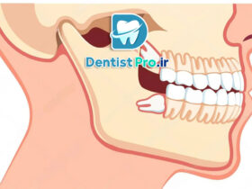 کشیدن دندان عقل با کمترین تورم: راهنمای جامع و علمی