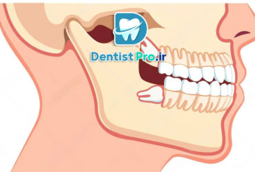 کشیدن دندان عقل با کمترین تورم: راهنمای جامع و علمی