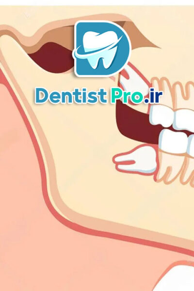 کشیدن دندان عقل با کمترین تورم: راهنمای جامع و علمی
