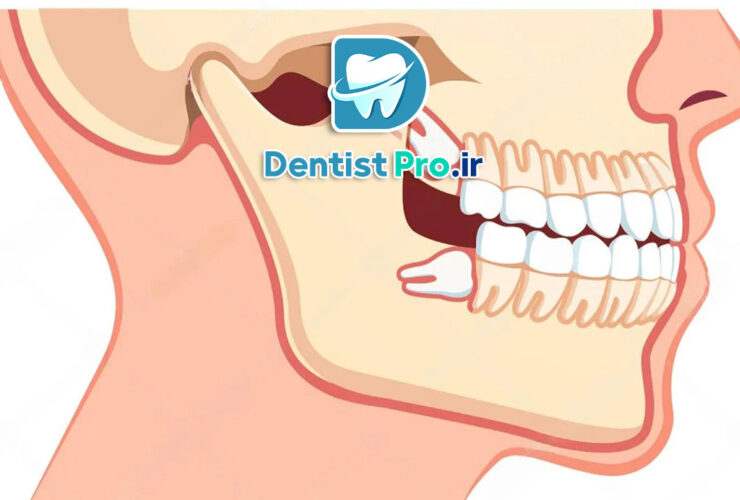 کشیدن دندان عقل با کمترین تورم: راهنمای جامع و علمی