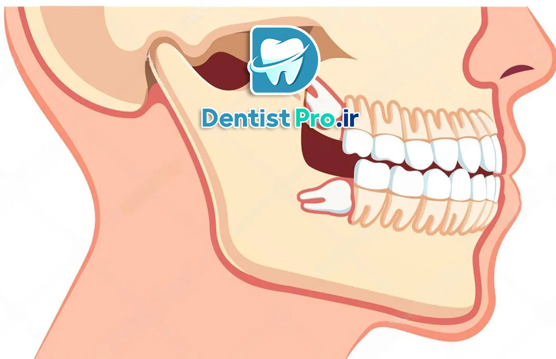 کشیدن دندان عقل با کمترین تورم: راهنمای جامع و علمی