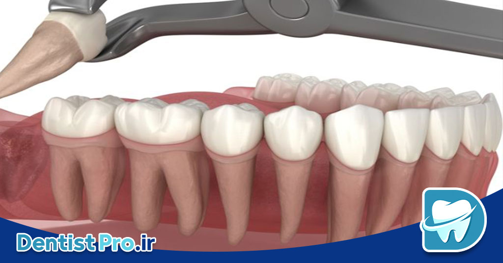 کشیدن دندان عقل با کمترین تورم: راهنمای جامع و علمی