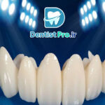 روکش زیرکونیا با استحکام بالا و رنگ طبیعی