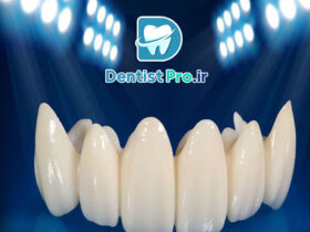 روکش زیرکونیا با استحکام بالا و رنگ طبیعی