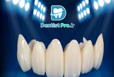 روکش زیرکونیا با استحکام بالا و رنگ طبیعی