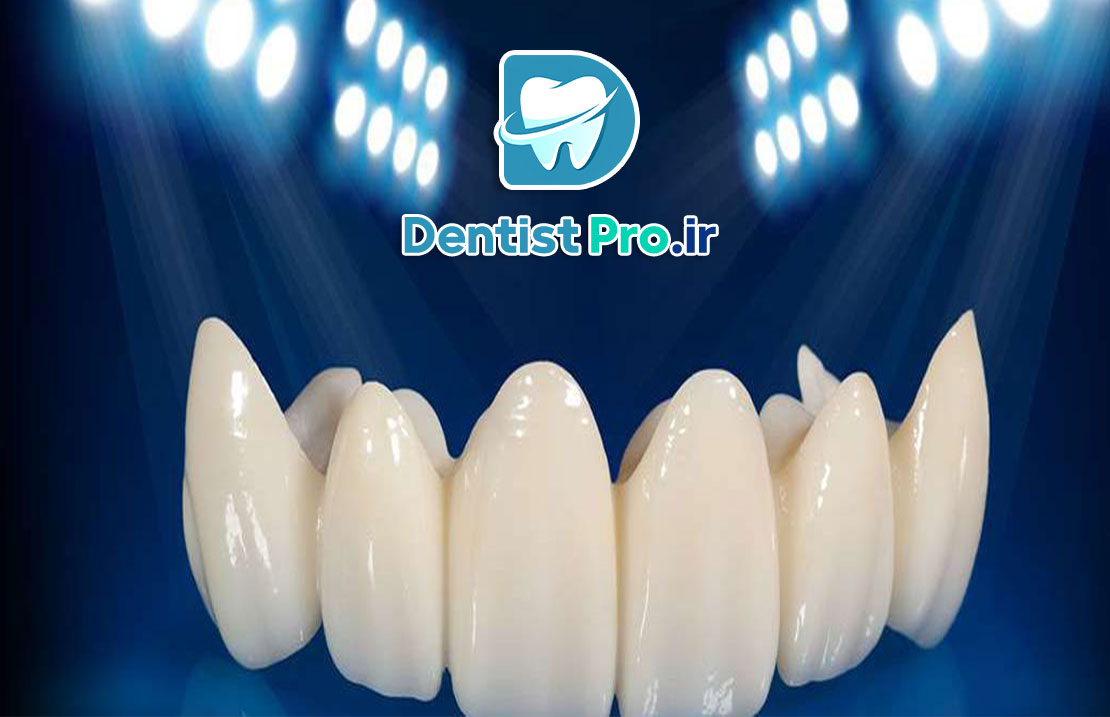 روکش زیرکونیا با استحکام بالا و رنگ طبیعی 25 روکش زیرکونیا با استحکام بالا و رنگ طبیعی