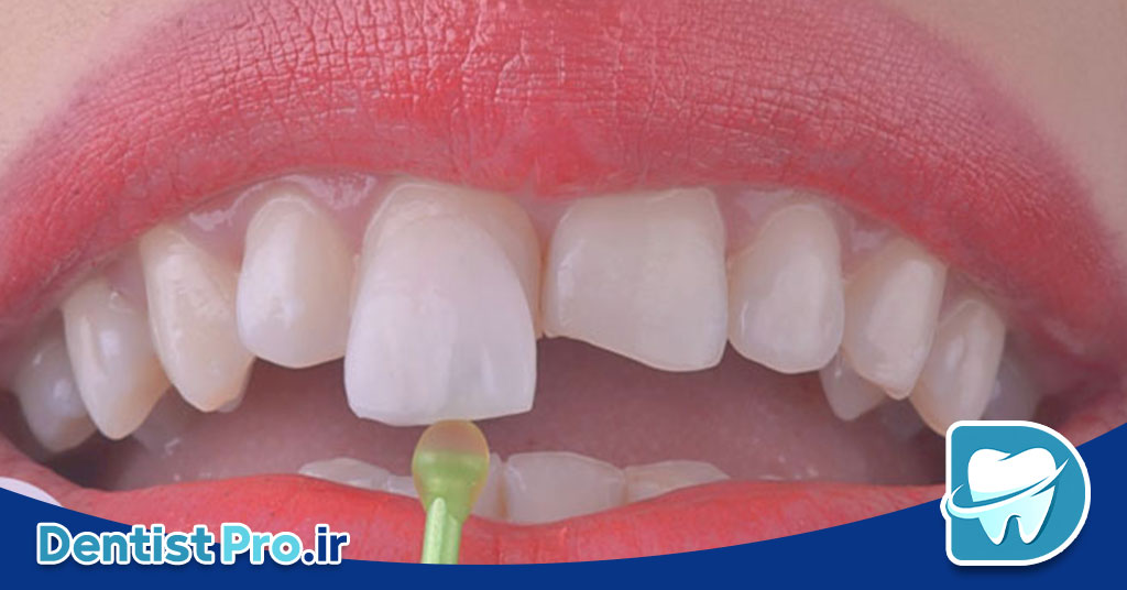 روکش زیرکونیا با استحکام بالا و رنگ طبیعی 26 روکش زیرکونیا با استحکام بالا و رنگ طبیعی