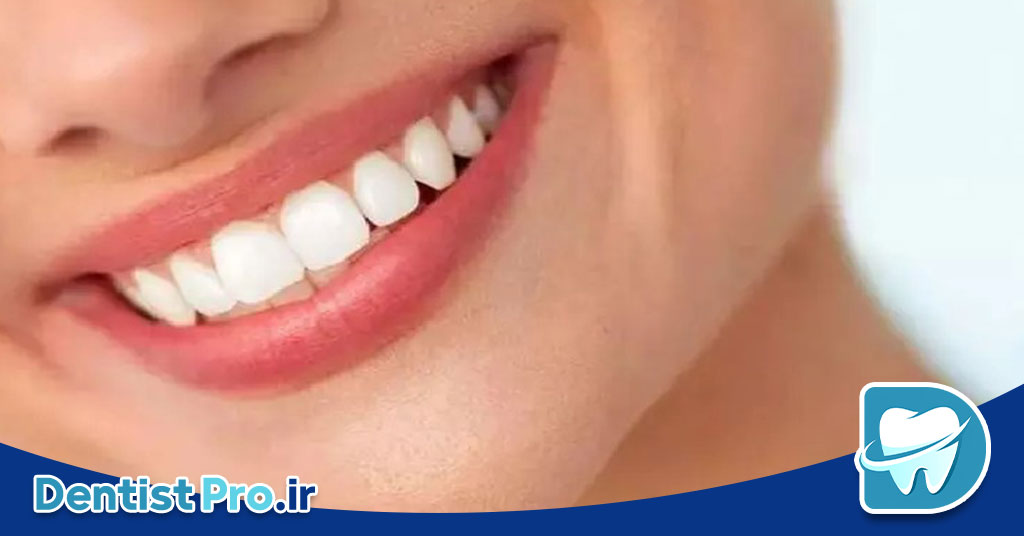 بهترین دکتر کامپوزیت برای لبخند طبیعی