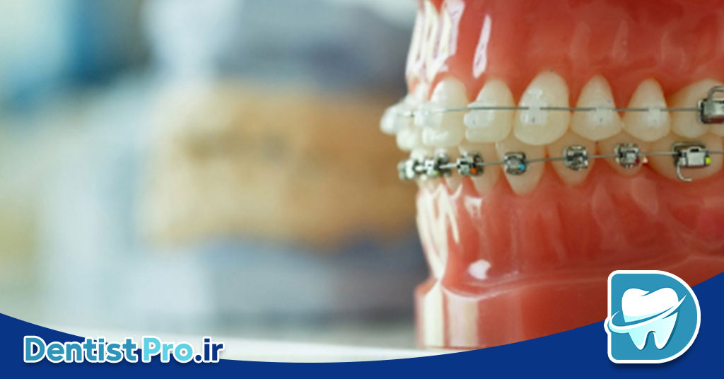 بهترین روش ارتودنسی سریع برای بزرگسالان شاغل