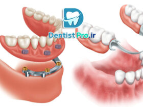 بهترین پروتز ثابت برای افراد با فک بی دندان