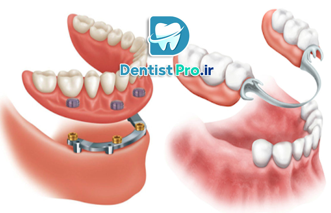 بهترین پروتز ثابت برای افراد با فک بی دندان
