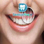 بهترین برند ایمپلنت برای جبران دندان از دست رفته چیست؟