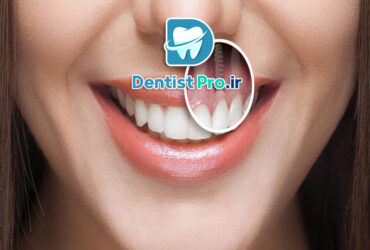 بهترین برند ایمپلنت برای جبران دندان از دست رفته چیست؟