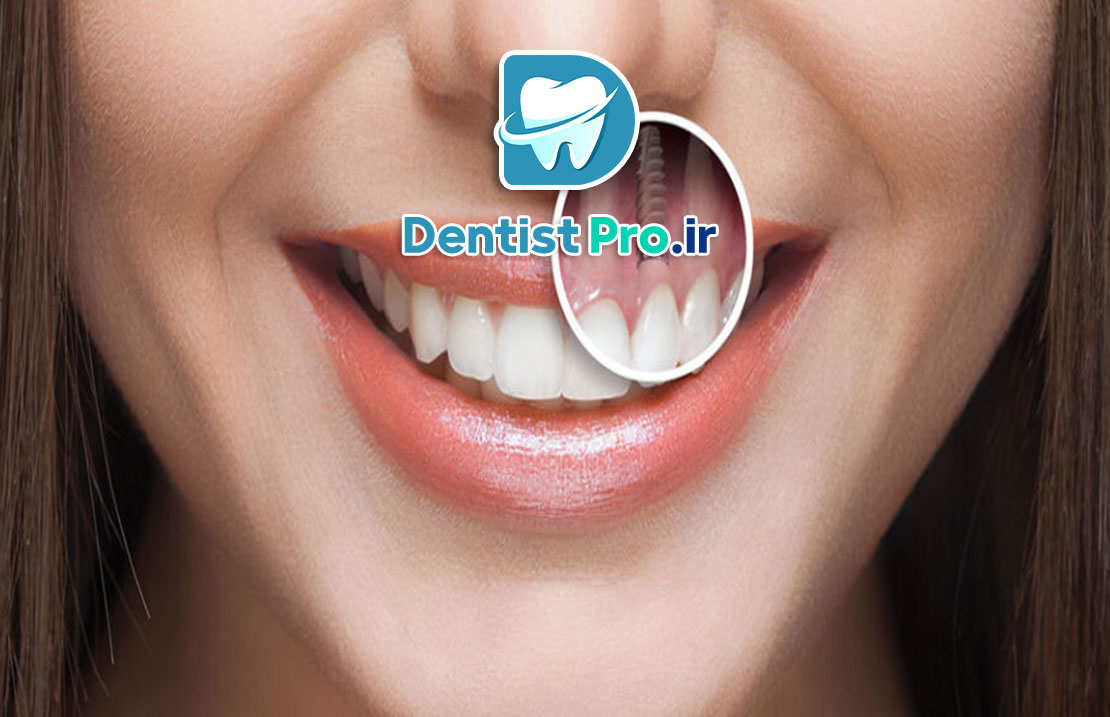 بهترین برند ایمپلنت برای جبران دندان از دست رفته چیست؟