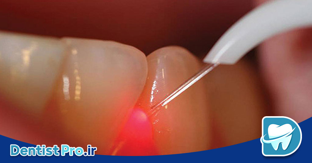 بهترین روش عصب کشی بدون درد 26 بهترین روش عصب کشی بدون درد