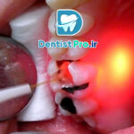 بهترین روش عصب کشی بدون درد