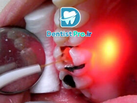 بهترین روش عصب کشی بدون درد