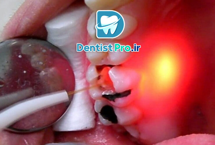 بهترین روش عصب کشی بدون درد 39 بهترین روش عصب کشی بدون درد