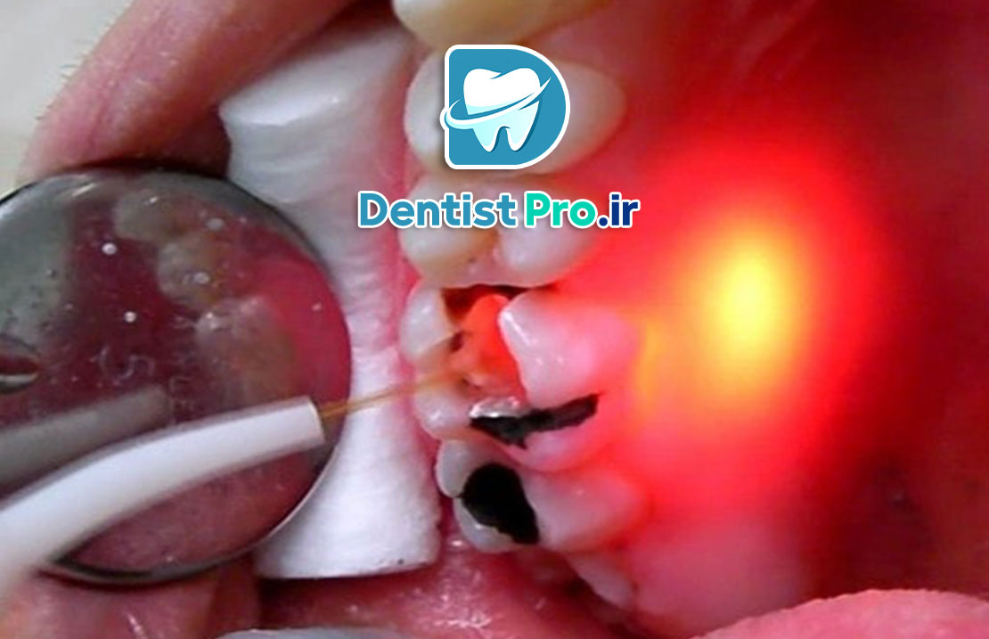 بهترین روش عصب کشی بدون درد 25 بهترین روش عصب کشی بدون درد