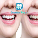 بهترین روش اصلاح طرح لبخند برای دندان ها