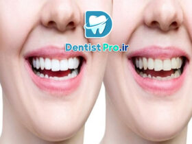 بهترین روش اصلاح طرح لبخند برای دندان ها