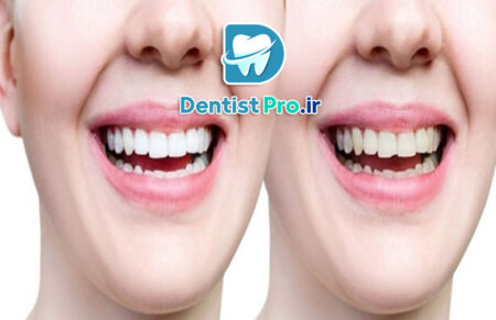 بهترین روش اصلاح طرح لبخند برای دندان ها