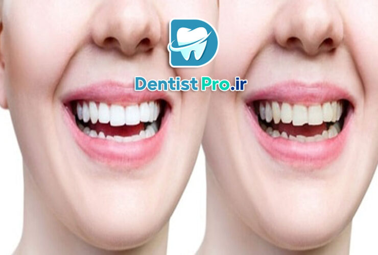 بهترین روش اصلاح طرح لبخند برای دندان ها 31 بهترین روش اصلاح طرح لبخند برای دندان ها