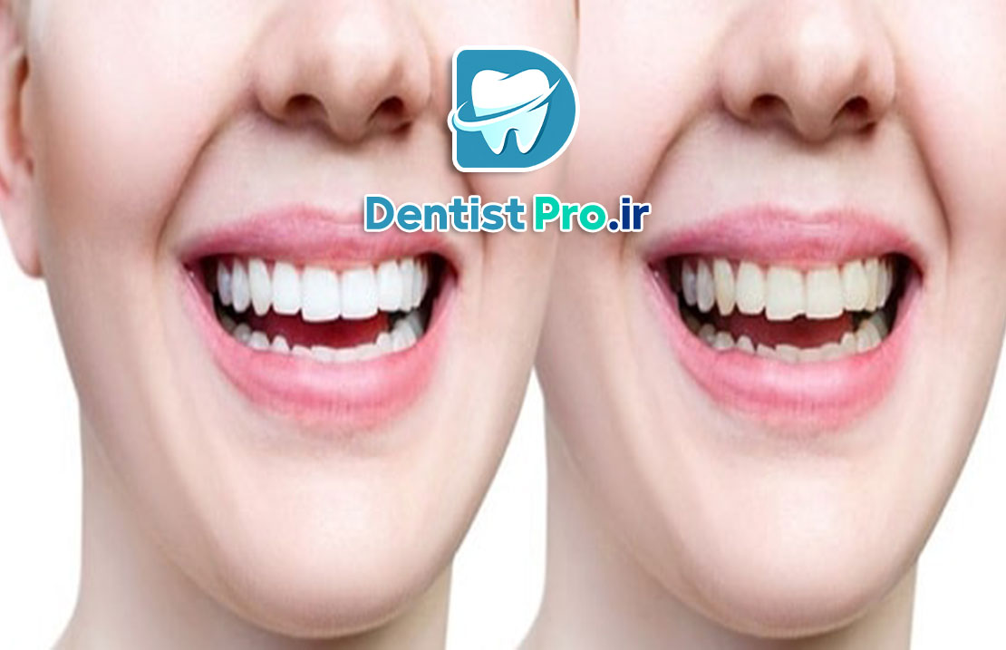 بهترین روش اصلاح طرح لبخند برای دندان ها 25 بهترین روش اصلاح طرح لبخند برای دندان ها