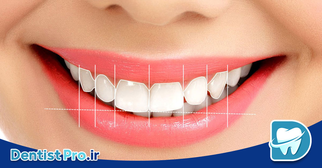 بهترین روش اصلاح طرح لبخند برای دندان ها 26 بهترین روش اصلاح طرح لبخند برای دندان ها
