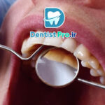 بهترین روش جرم گیری بدون آسیب مینای دندان