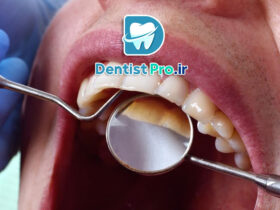 بهترین روش جرم گیری بدون آسیب مینای دندان