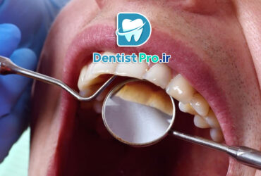 بهترین روش جرم گیری بدون آسیب مینای دندان