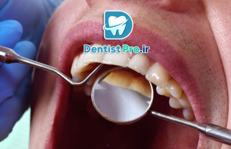 بهترین روش جرم گیری بدون آسیب مینای دندان