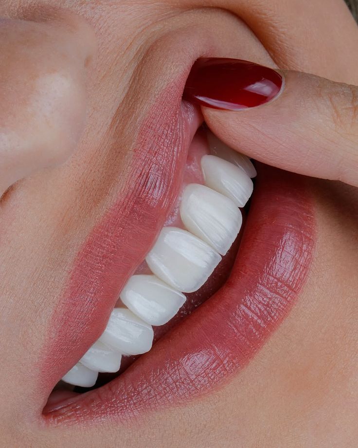 لمینت دندان