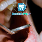 تفاوت عصب کشی معمولی و تخصصی اندودنتیست