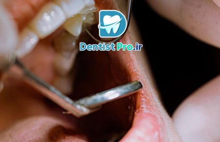 تفاوت عصب کشی معمولی و تخصصی اندودنتیست