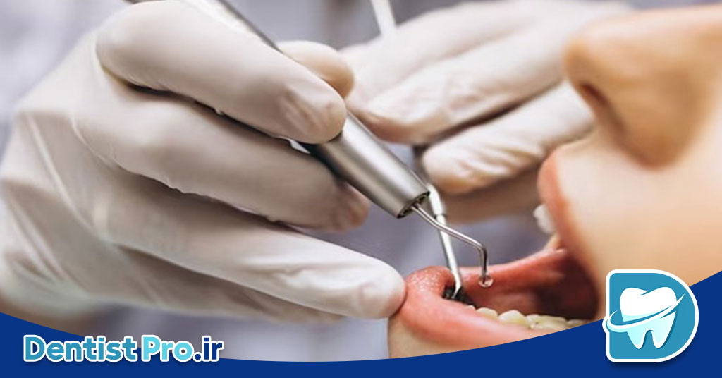 تفاوت عصب کشی معمولی و تخصصی اندودنتیست