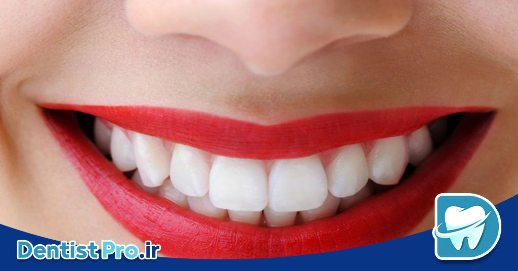 تفاوت لمینت و کامپوزیت در جلوه لبخند 26 تفاوت لمینت و کامپوزیت در جلوه لبخند