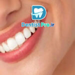 تفاوت لمینت و کامپوزیت در جلوه لبخند